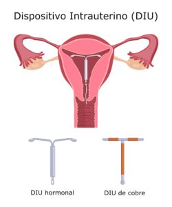 Dispositivo Intra Uterino - DIU