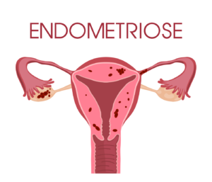 Exemplo de endometriose